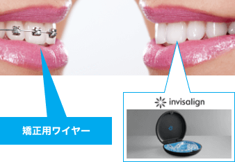 インビザライン